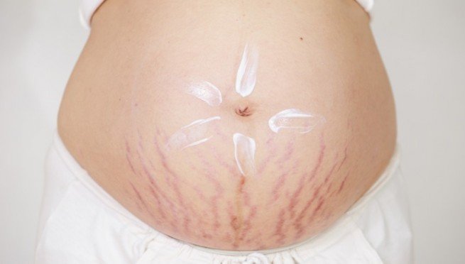 hamilelik-catlaklari-tedavisi